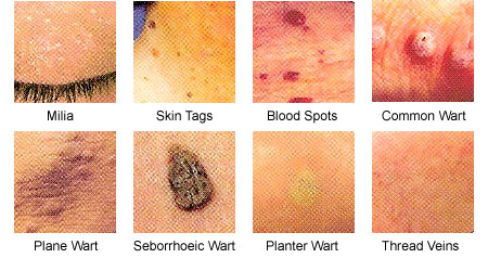 Skin Tags Removal Guide