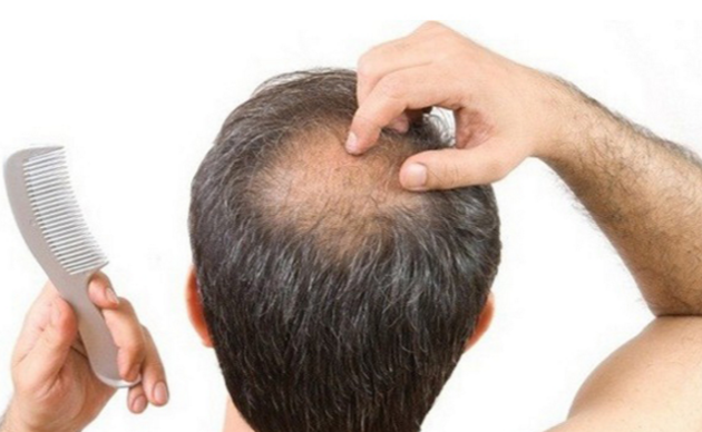 Treatments for Hair Loss That Always Work