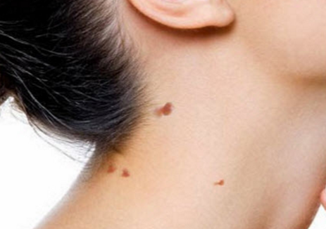 Removing Skin Tags