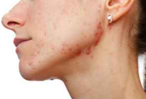 Adult Acne Treatments