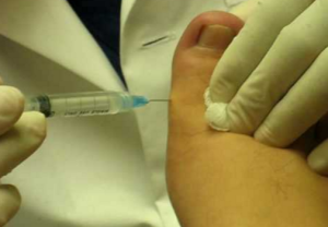 ingrown toenail surgery