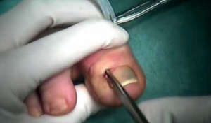 ingrown toenail surgery