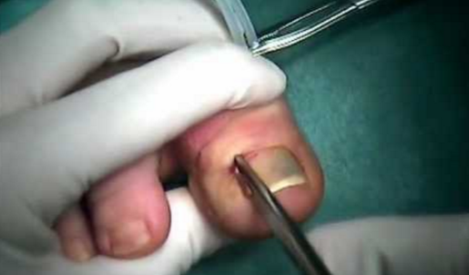 4 Ways of Preventing Ingrown Toenails