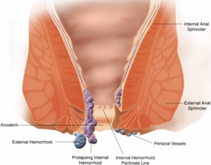 Hemorrhoids